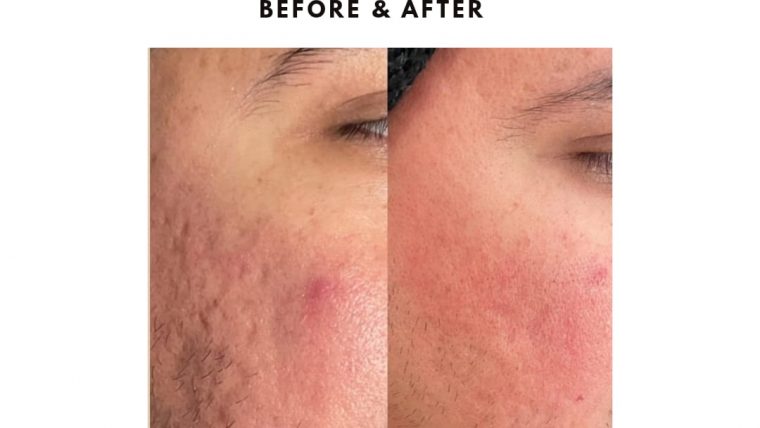 Best Acne Scar Treatment in Islamabad