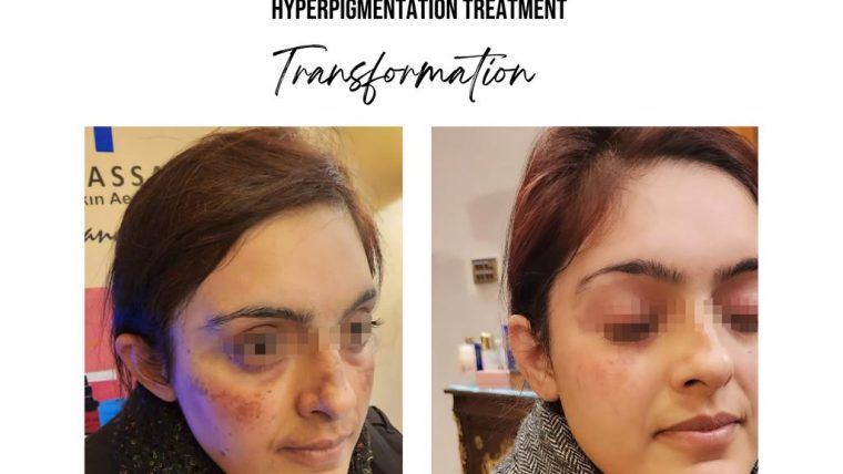 Hyperpigmentation Treatment in Islamabad