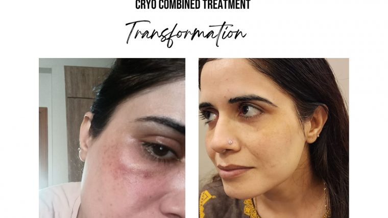 Cryo Combined Treatment in Islamabad