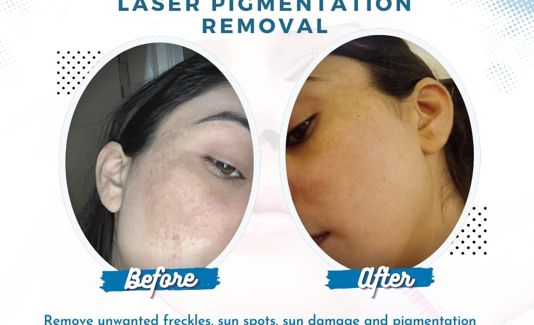 Laser Treatment in Islamabad