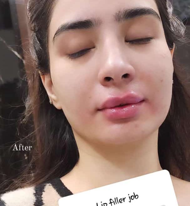 Lip Filler Treatment in Islamabad