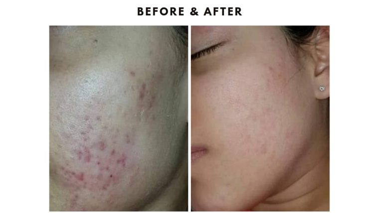 Acne Scars Treatment in Islamabad
