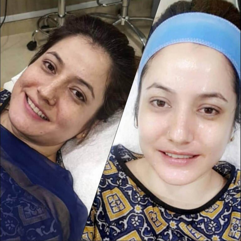 skin whitening treatment Shah Hassan’s
