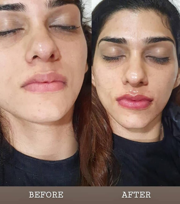 hydrafacial islamabad