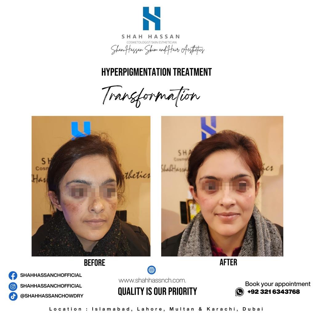 Reach out to Shah Hassan Chowdry for a consultation. As a specialist in pigmentation treatment in Islamabad, he can guide you through the process, ensuring you receive the best possible care tailored to your needs.