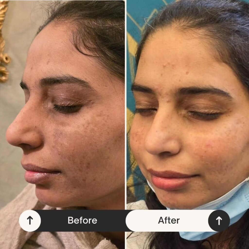 Pigmentation Treatment in Islamabad – Flawless Skin Awaits