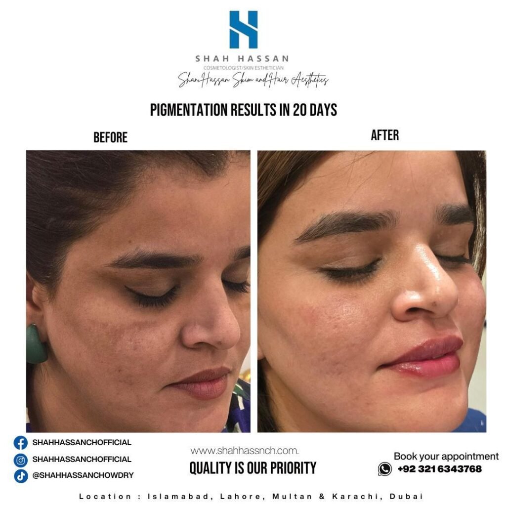 Acne Treatment in Islamabad – Effective Solutions for Clear Skin