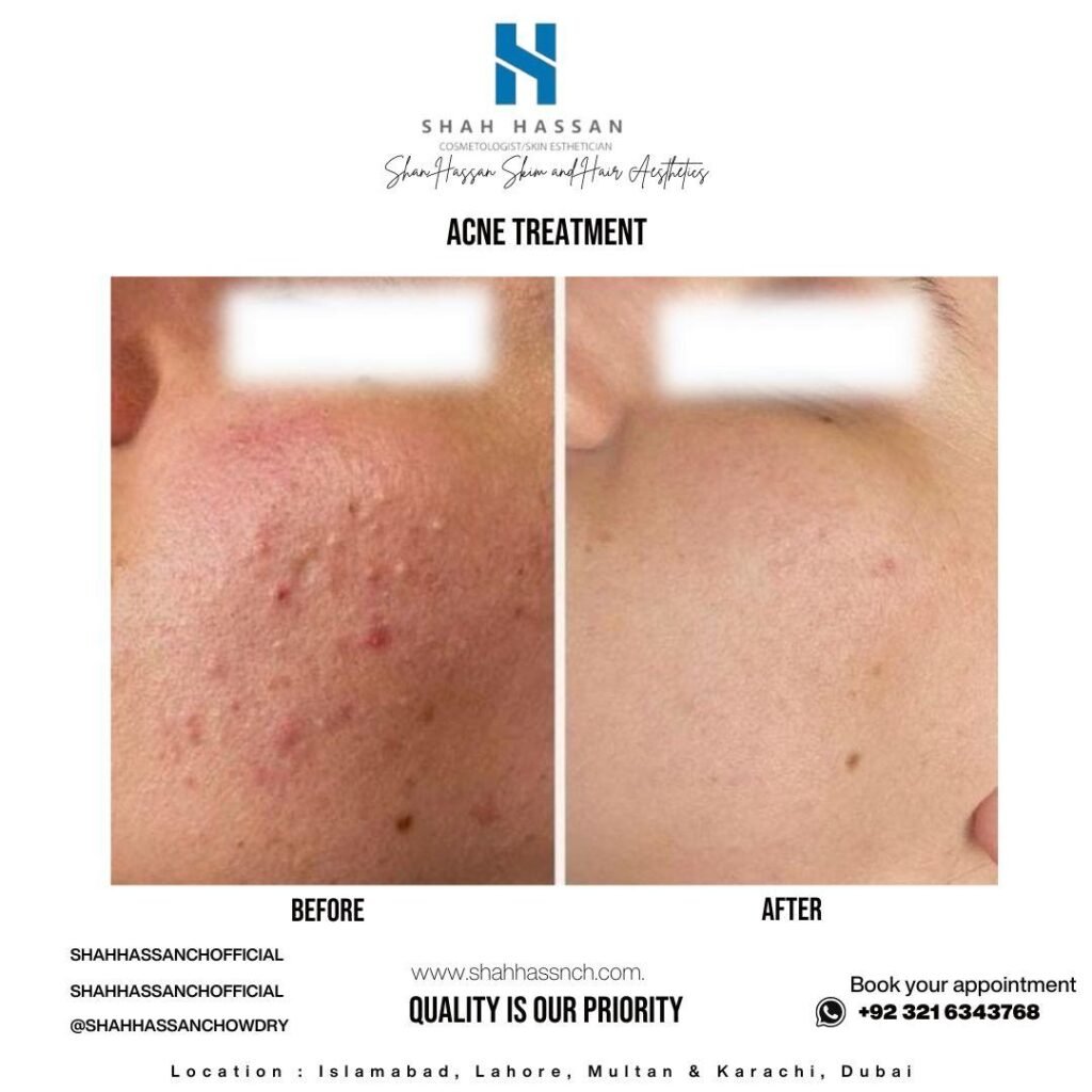 Acne Scar Removal