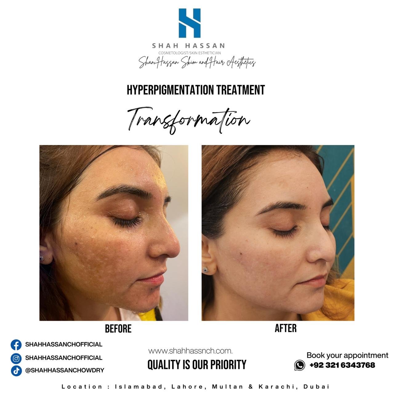 Specialized Pigmentation Treatments for Flawless Skin