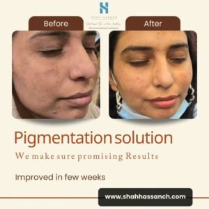 Pigmentation treatment and skin care in Pakistan