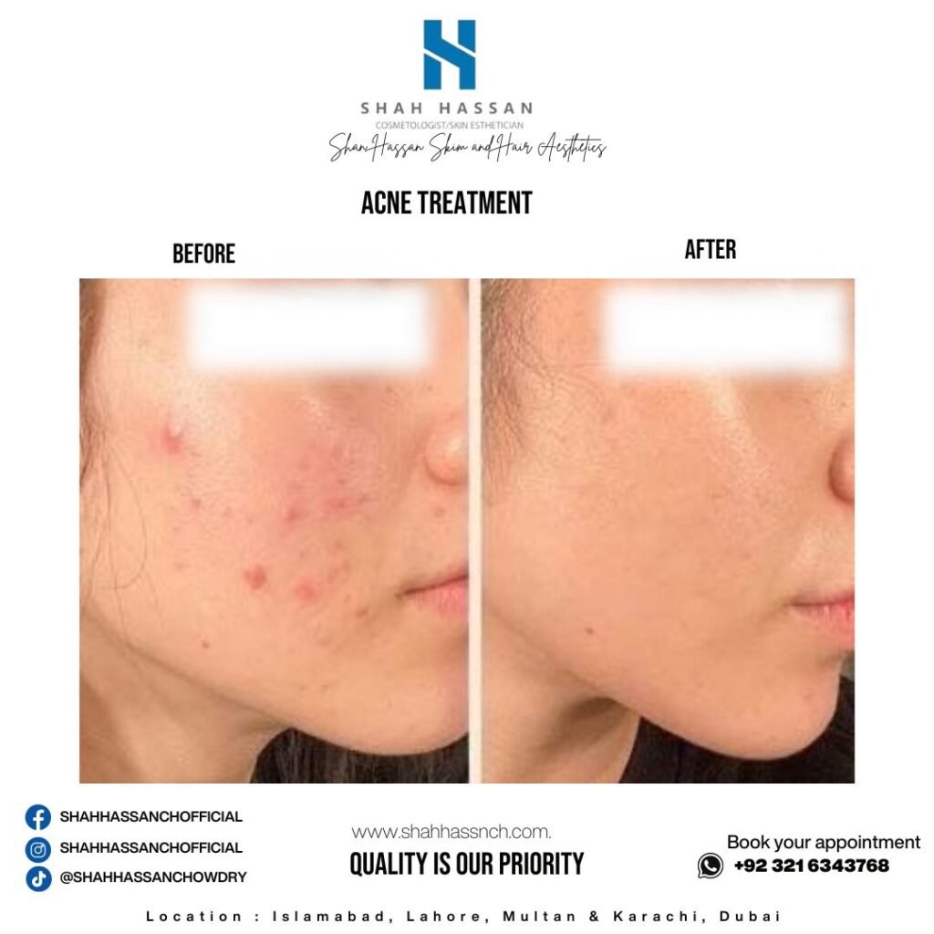 Acne Treatment in