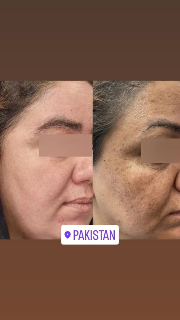 Advanced Pigmentation