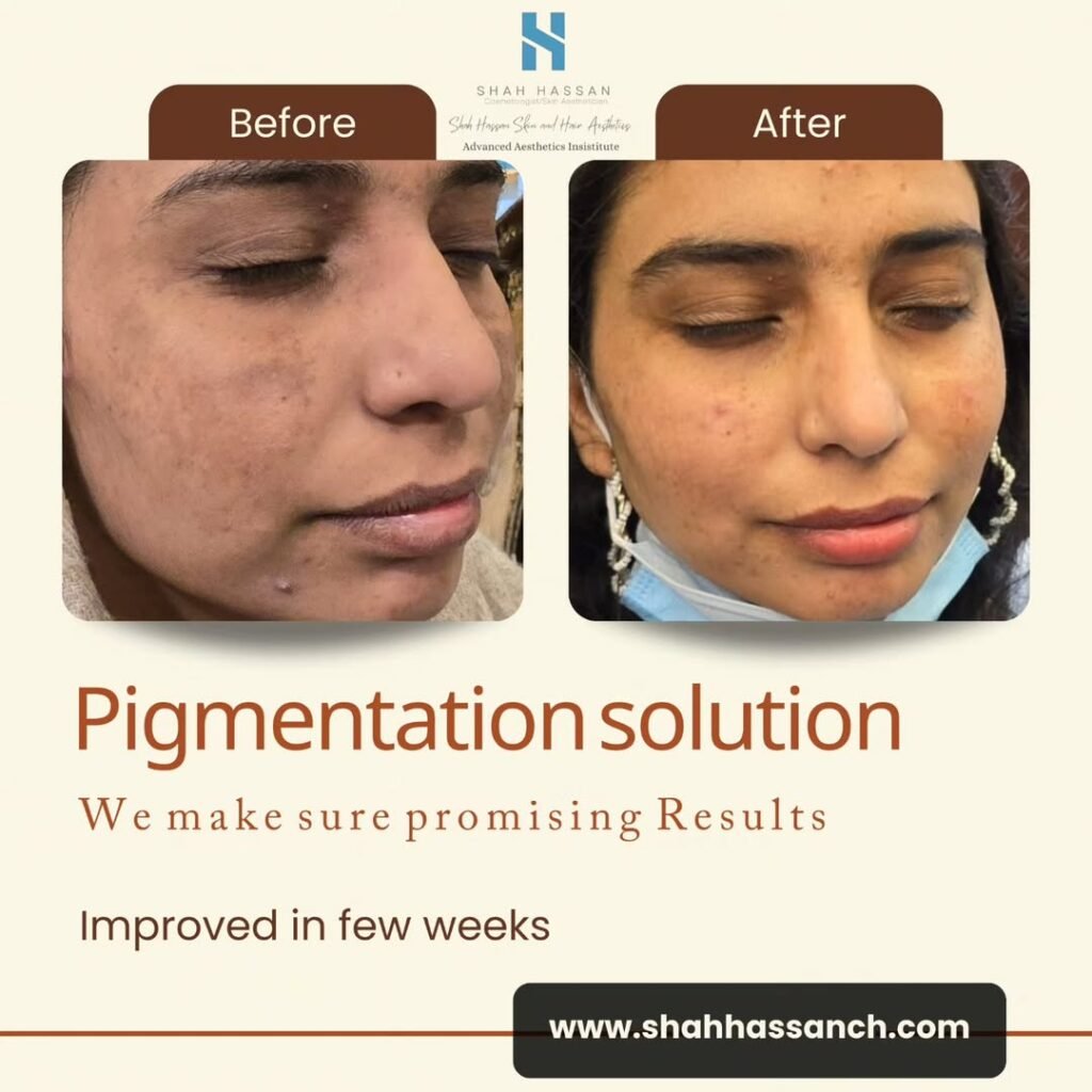Close-up of skin improvement after melasma treatment
