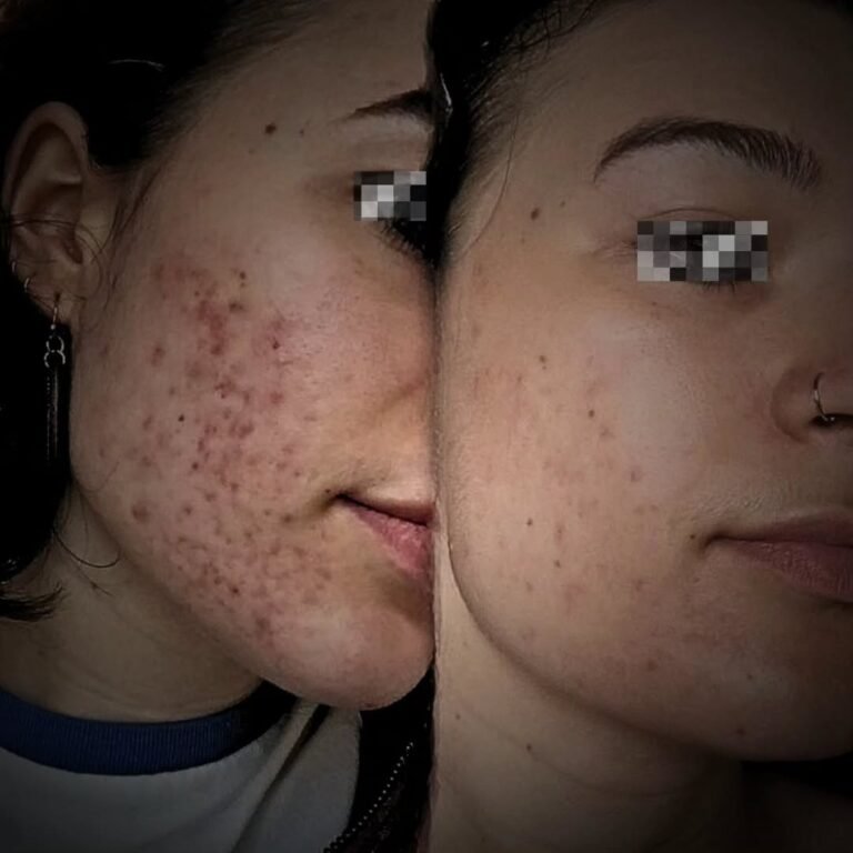 Acne Treatment in