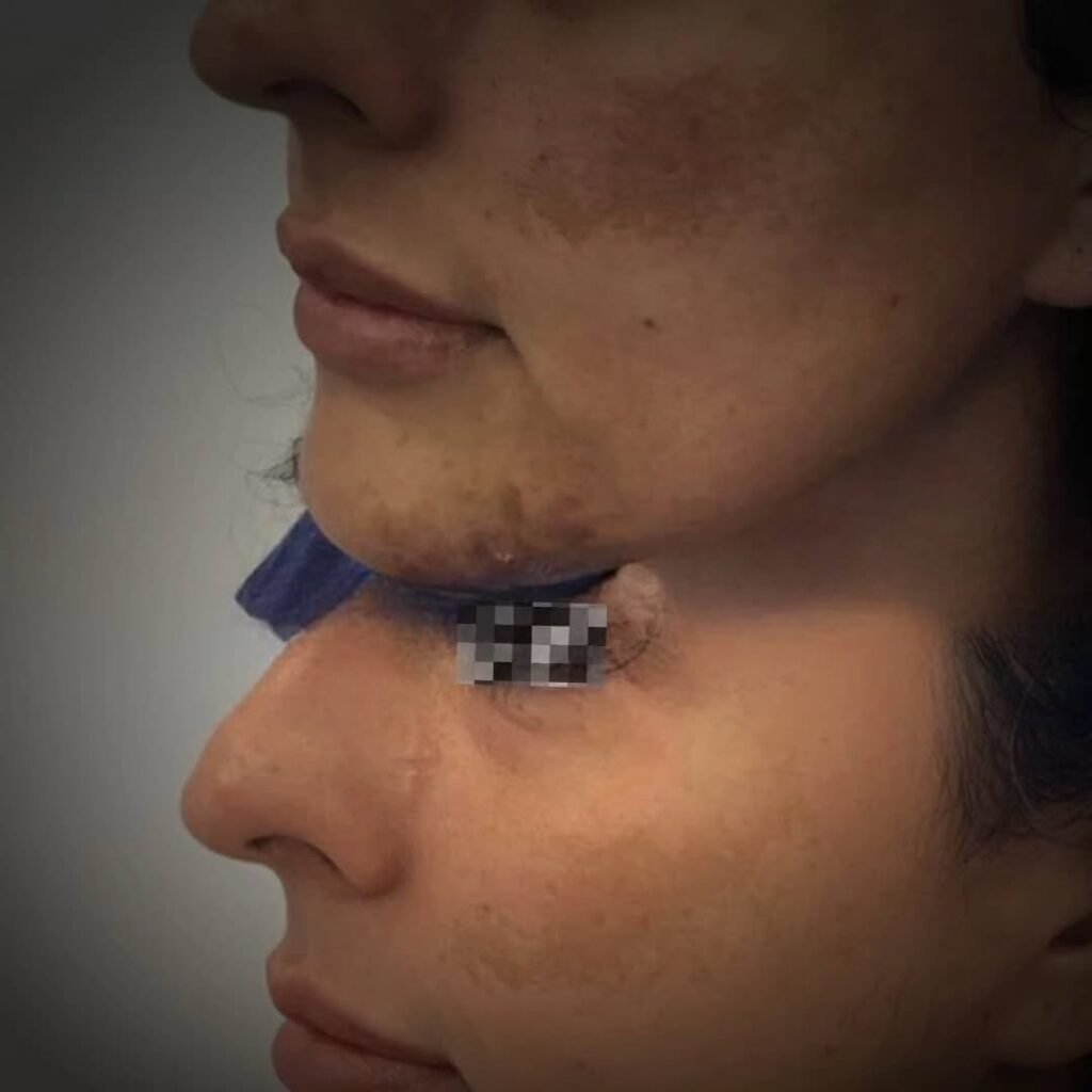 Melasma treatment at Shah Hassan Aesthetics