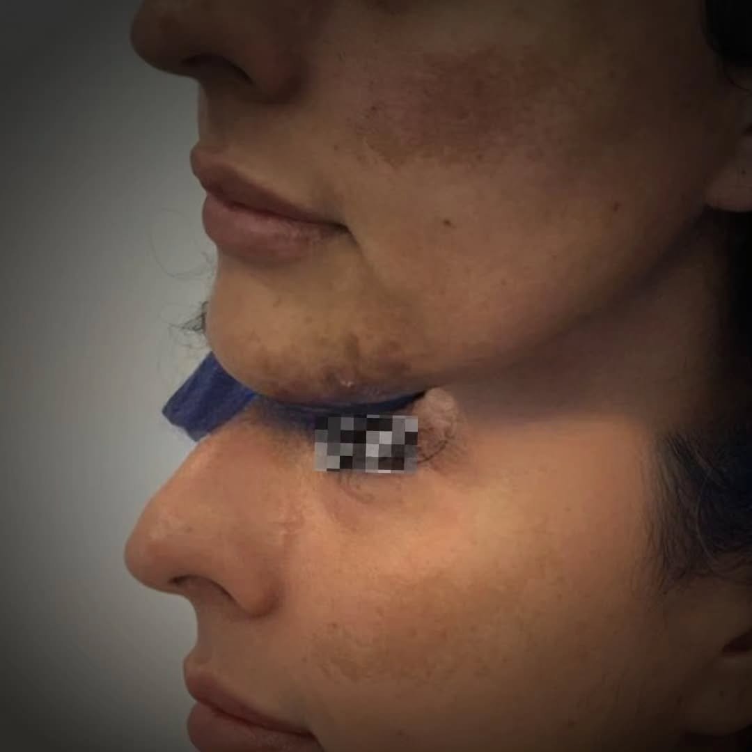 Dermatologist examining melasma on a patient's cheeks