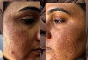 Best treatment for pigmentation