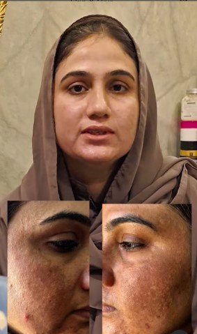 Best treatment for pigmentation