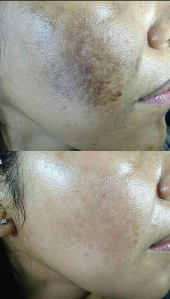 Pigmentation