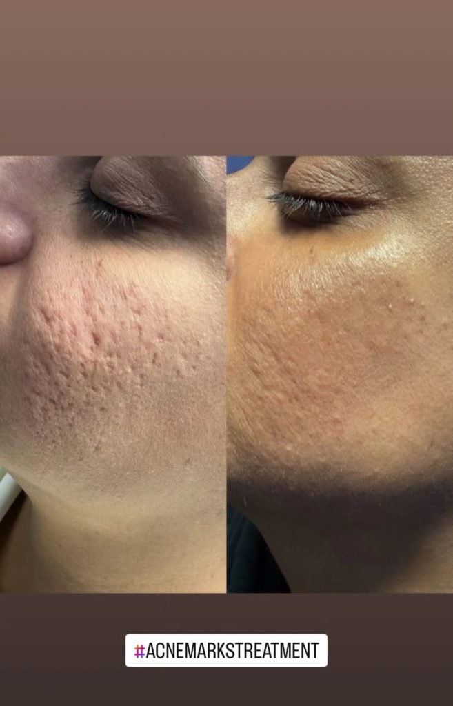 Acne Scars Treatment