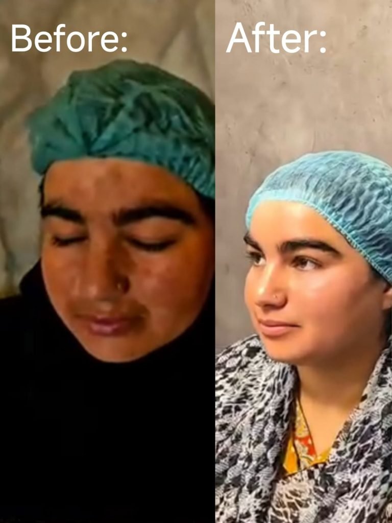 Starting Melasma Treatment