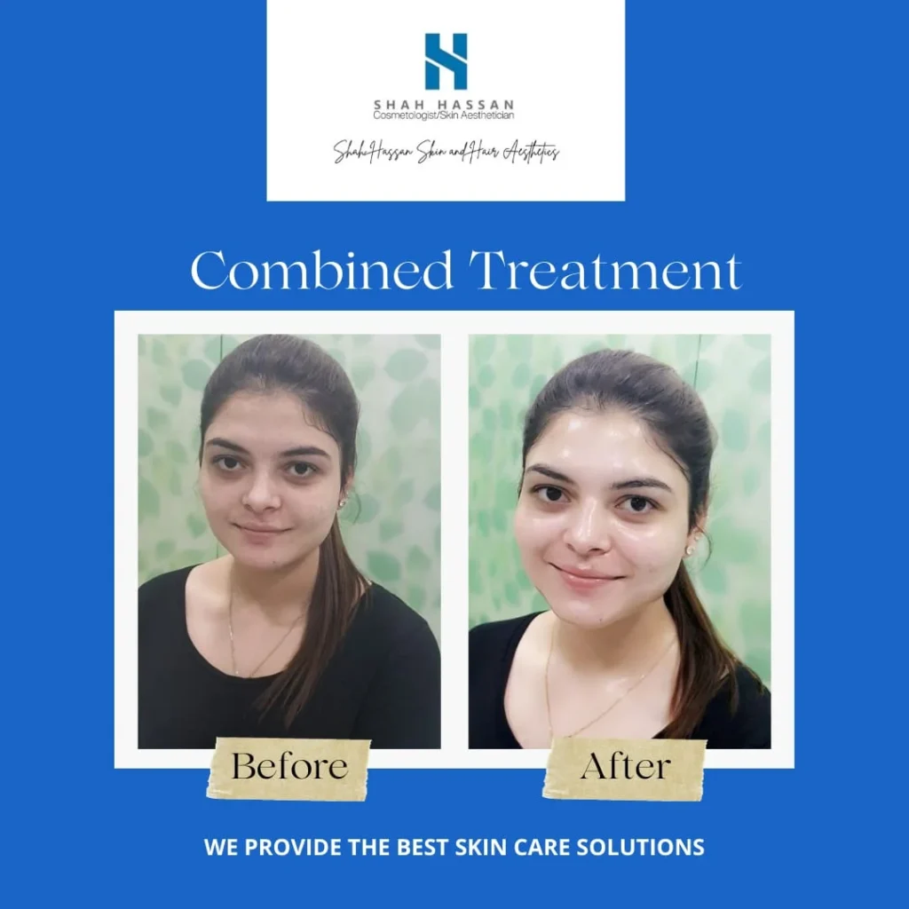 HydraFacial Treatment