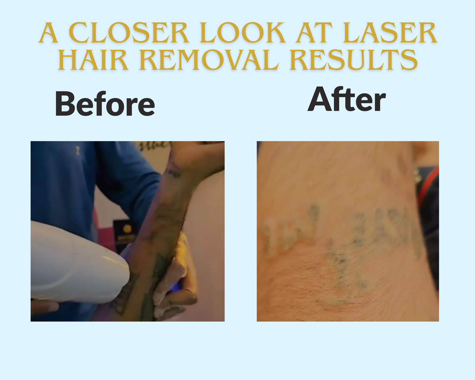 Before and after comparison of laser tattoo removal fading results