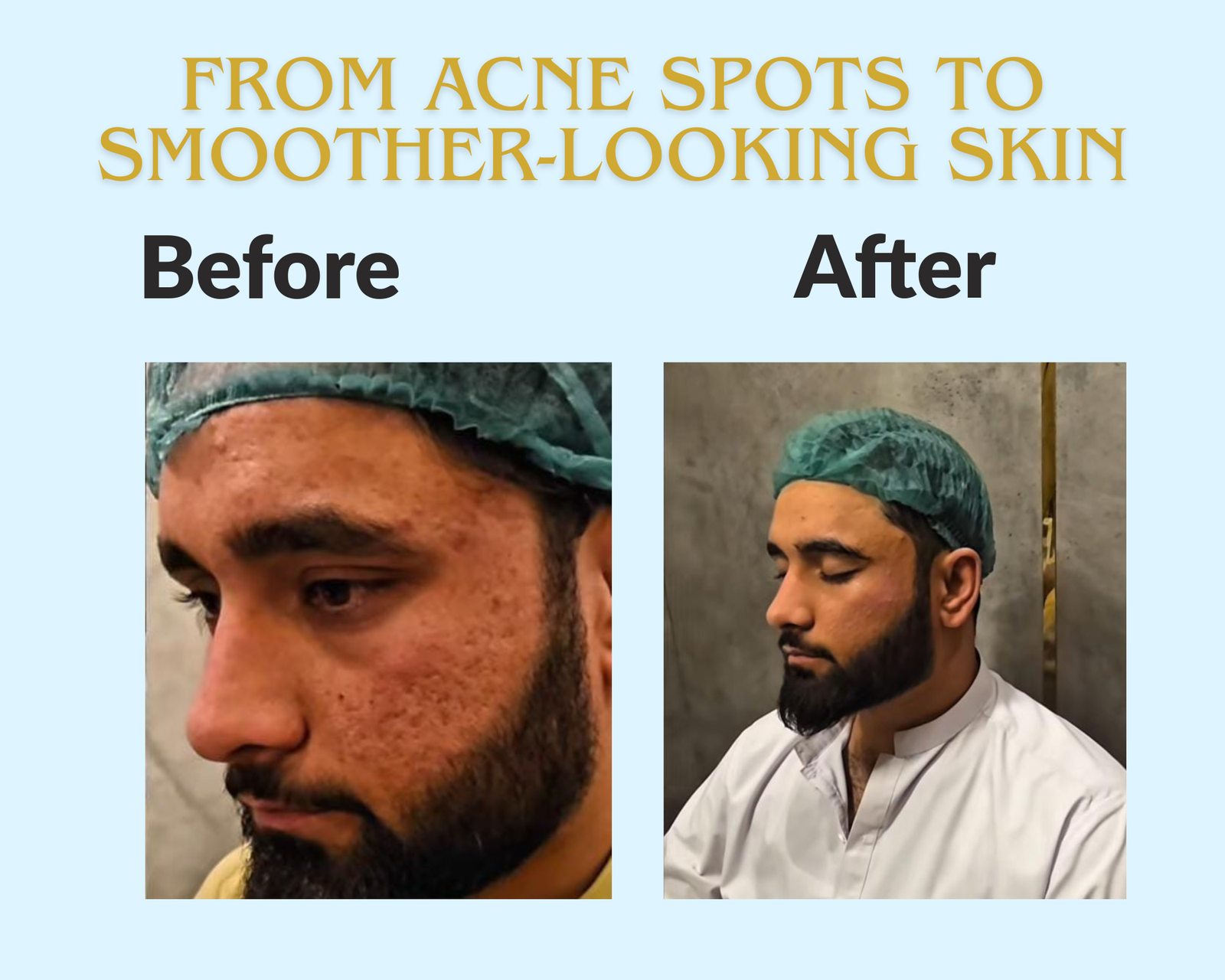 Before and after comparison of acne spots meso treatment results