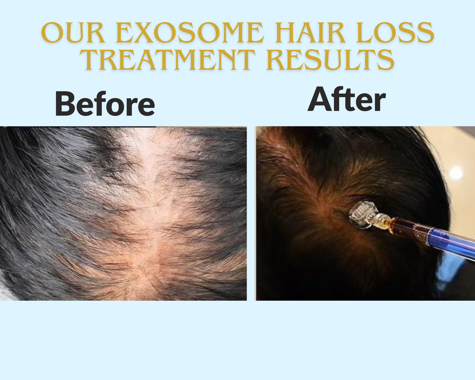 Before and after comparison of exosome hair loss treatment results