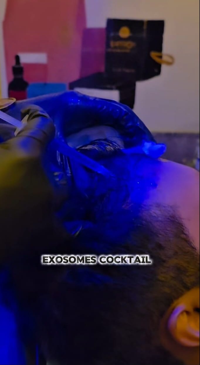 Exosome cocktail solution being applied to the scalp during a treatment session