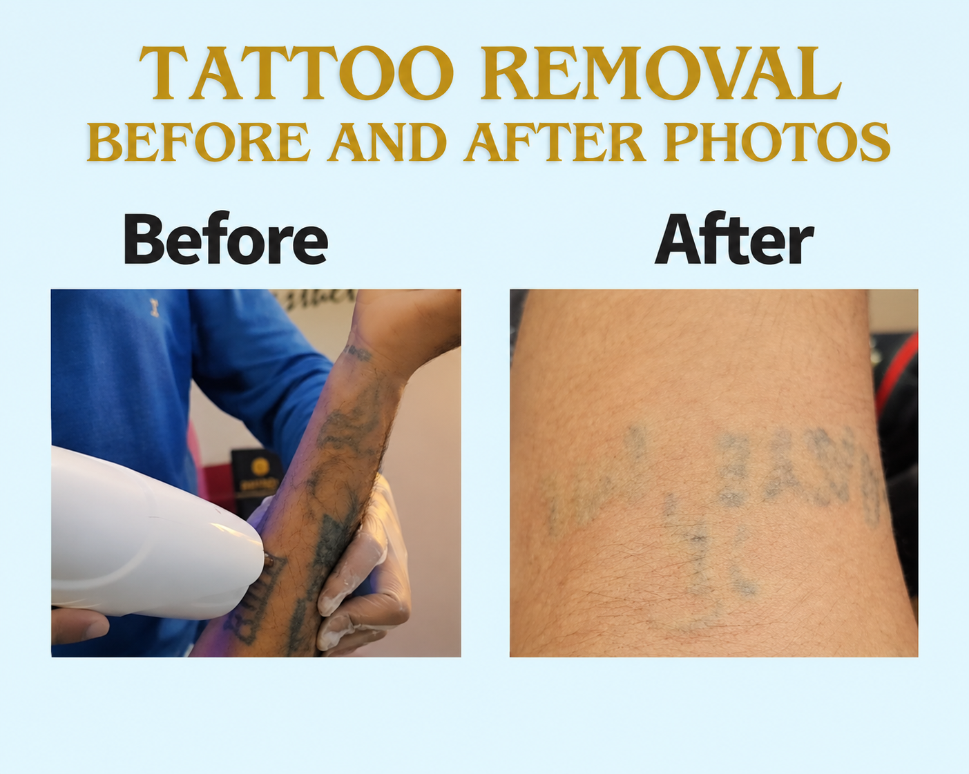 Tattoo removal before and after results with patient consent